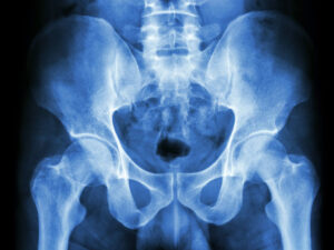 Read more about the article So this one time… when I broke my pelvis… Part 3 (of 3)